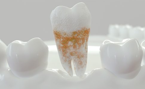 Placa dental salud bucal