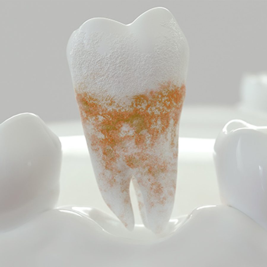Placa dental: ¿qué es y cómo eliminarla?