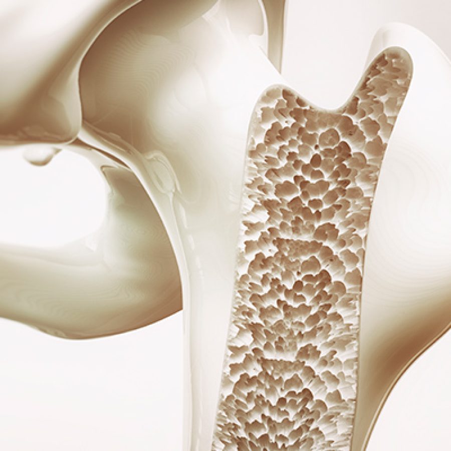 Implantes dentales y osteoporosis: ¿son compatibles?